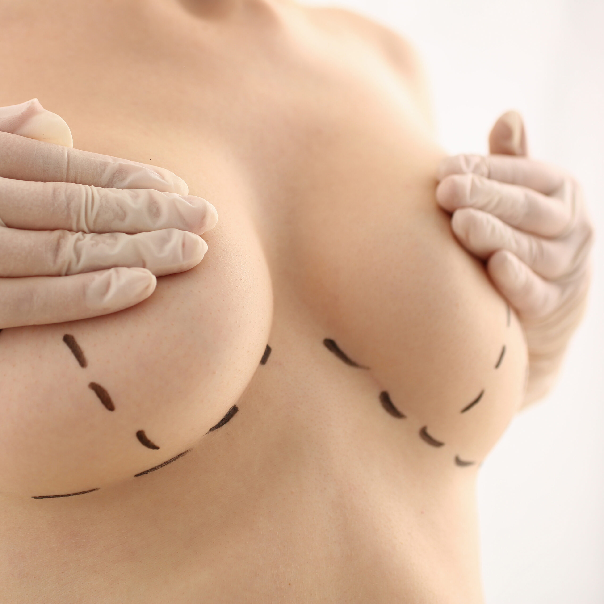 Female patient pre breast surgery
