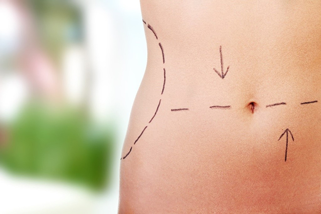 Can Liposuction and a Tummy Tuck Be Performed at the Same Time?