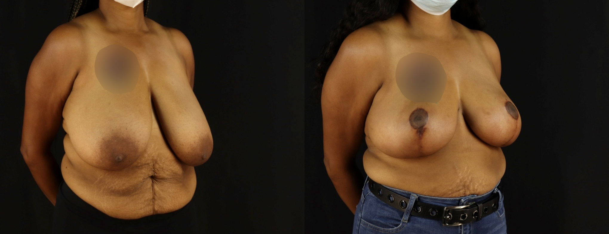 Breast Reduction before and after photo by Dr. Erika A. Sato in Houston TX