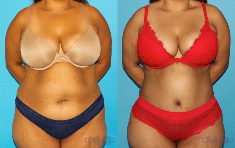 Tummy tuck before and after photo by Dr. Erika A. Sato in Houston, TX