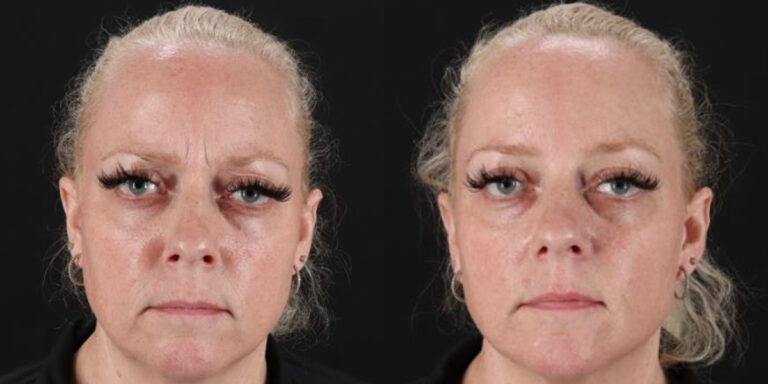 Botox before and after photo by Dr. Erika A. Sato in Houston TX