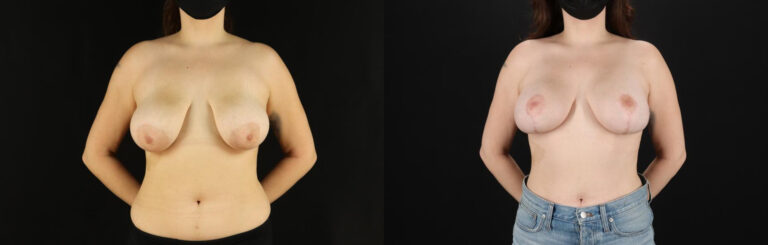 Breast Lift with Implants before and after photo by Dr. Erika A. Sato in Houston TX