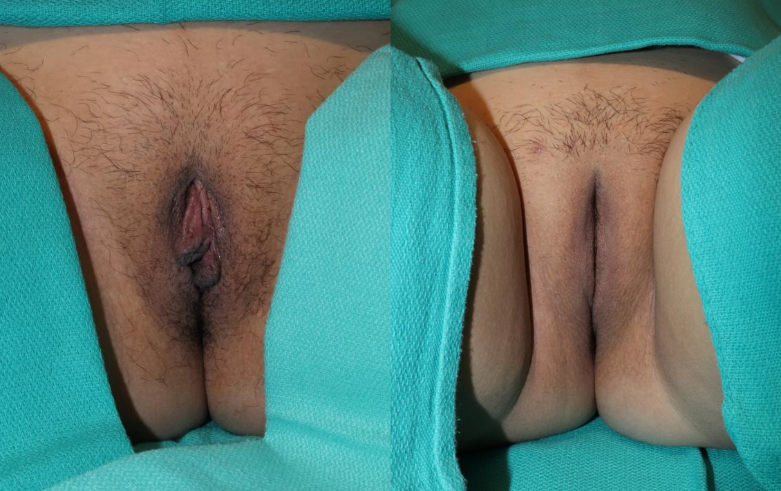 Labiaplasty before and after photo by Dr. Erika A. Sato in Houston TX