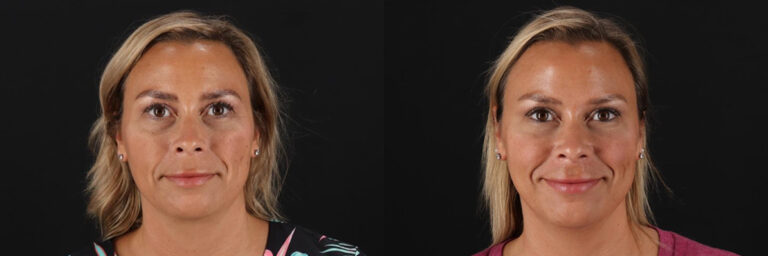 Botox before and after photo by Dr. Erika A. Sato in Houston TX