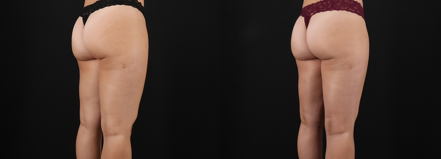 Liposuction before and after photo by Dr. Erika A. Sato in Houston TX