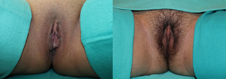 Labiaplasty before and after photo by Dr. Erika A. Sato in Houston TX copy