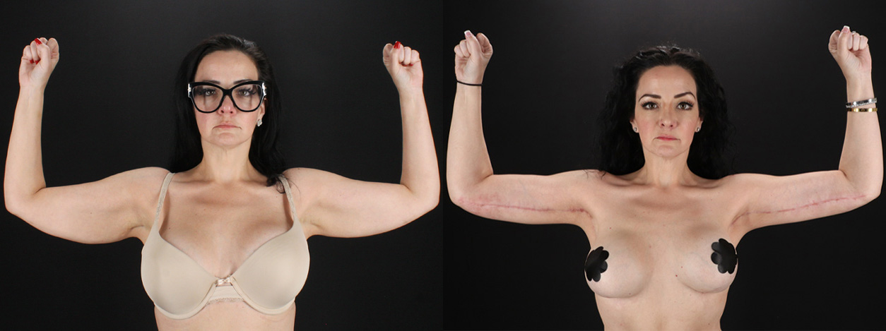 Arm Lift before and after photo by Dr. Erika A. Sato in Houston TX