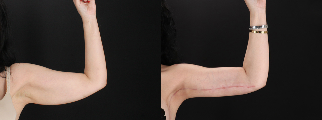 Arm Lift before and after photo by Dr. Erika A. Sato in Houston TX