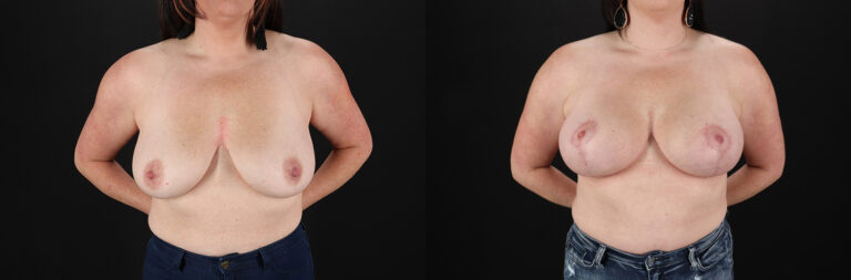 Breast Lift with Implants before and after photo by Dr. Erika A. Sato in Houston TX