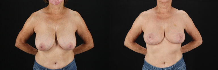Breast Reduction before and after photo by Dr. Erika A. Sato in Houston TX