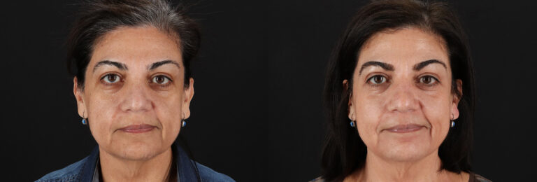 Chemical Peel before and after photo by Dr. Erika A. Sato in Houston TX