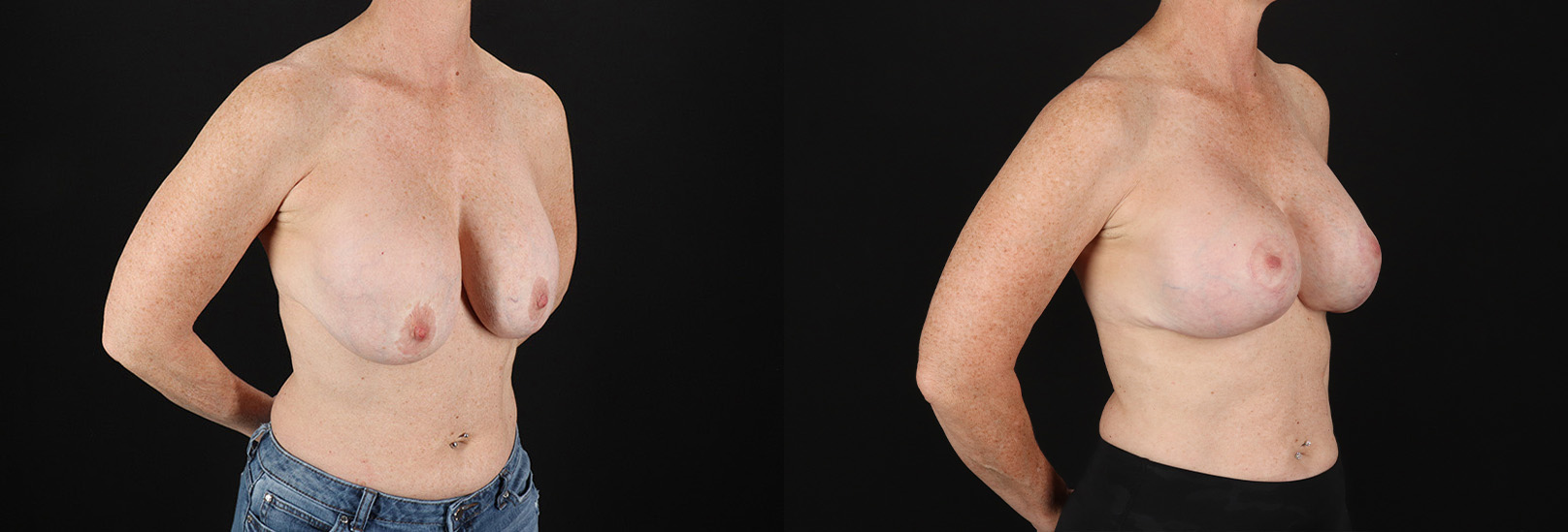 Revision Breast Surgery before and after photo by Dr. Erika A. Sato in Houston, TX