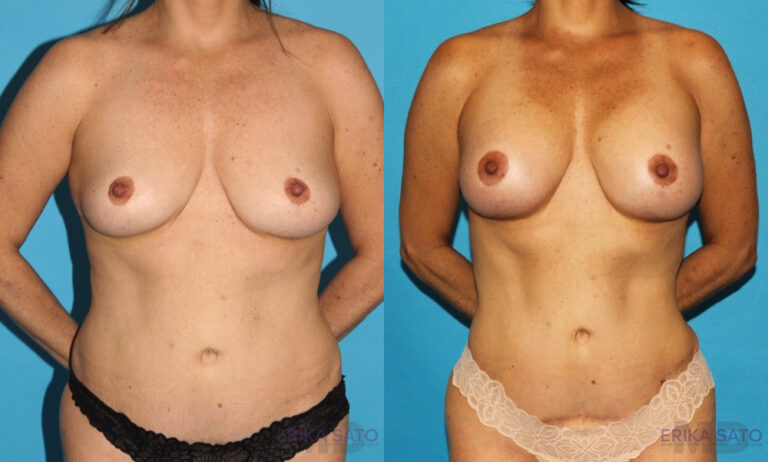 Breast Augmentation before and after photo by Dr. Erika A. Sato in Houston TX