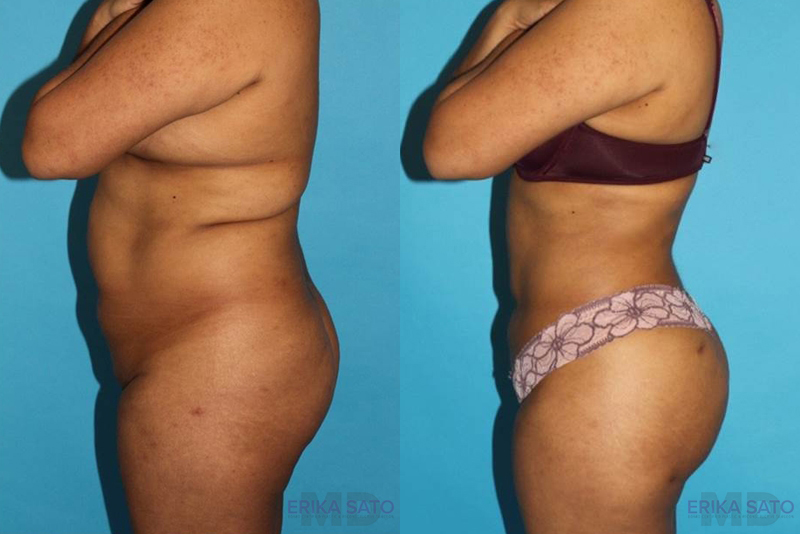of Brazilian Butt Lift before and after photo by Dr. Erika A. Sato in Houston TX