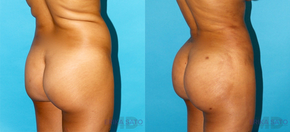 Brazilian Butt Lift before and after photo by Dr. Erika A. Sato in Houston TX