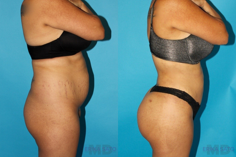 of Brazilian Butt Lift before and after photo by Dr. Erika A. Sato in Houston TX