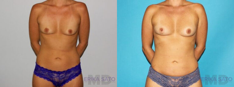 Fat Grafting to the Breast before and after photo by Dr. Erika A. Sato in Houston TX