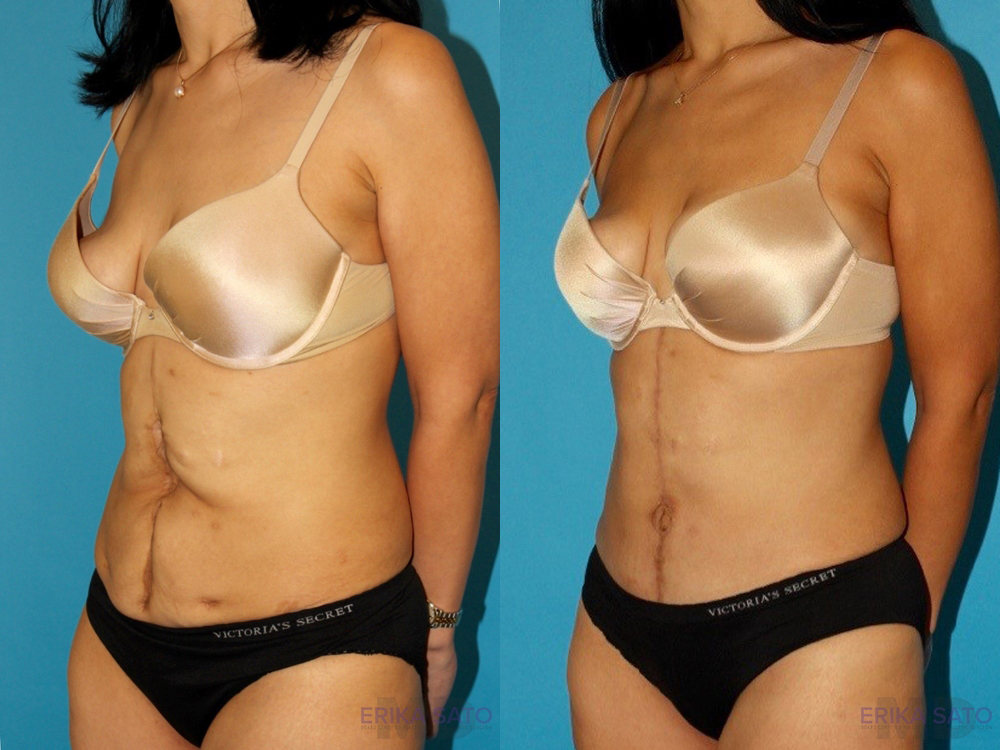 Post Bariatric Surgery Massive Weight Loss before and after photo by Dr. Erika A. Sato in Houston TX