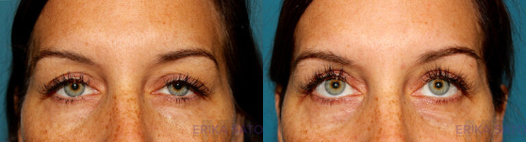 Blepharoplasty before and after photo by Dr. Erika A. Sato in Houston TX