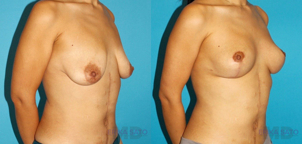Breast Lift before and after photo by Dr. Erika A. Sato in Houston TX