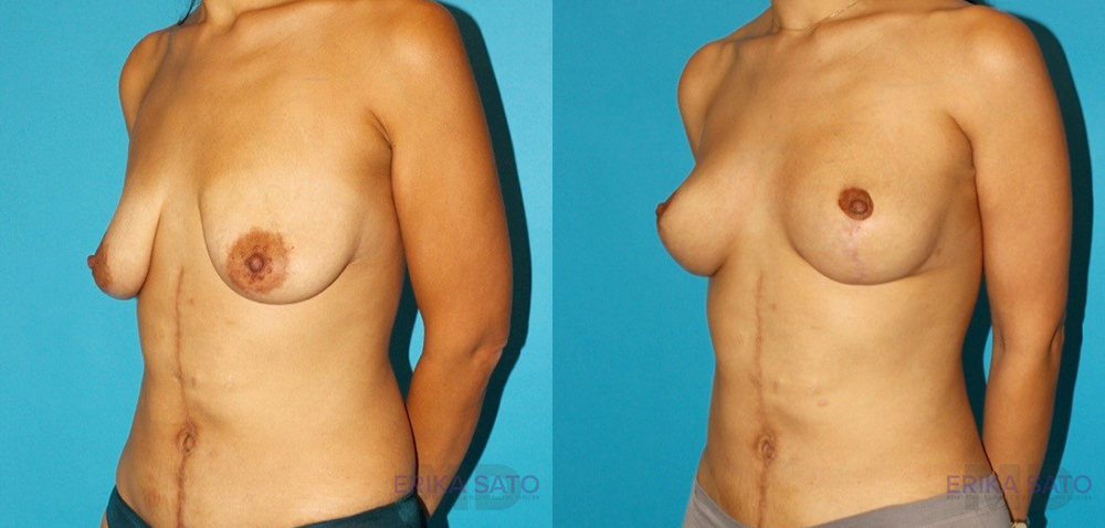 Breast Lift before and after photo by Dr. Erika A. Sato in Houston TX