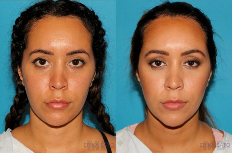 Submental Liposuction before and after photo by Dr. Erika A. Sato in Houston TX