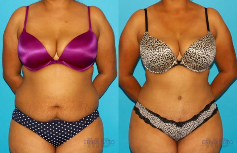 Tummy Tuck before and after photo by Dr. Erika A. Sato in Houston TX