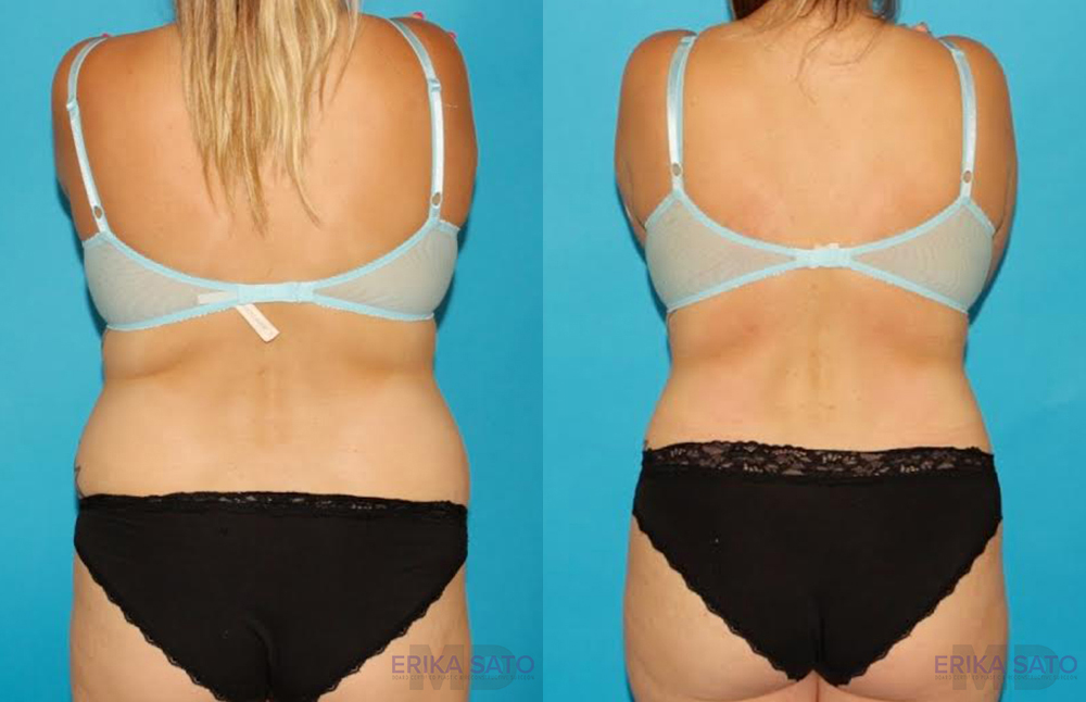 Tummy Tuck before and after photo by Dr. Erika A. Sato in Houston TX
