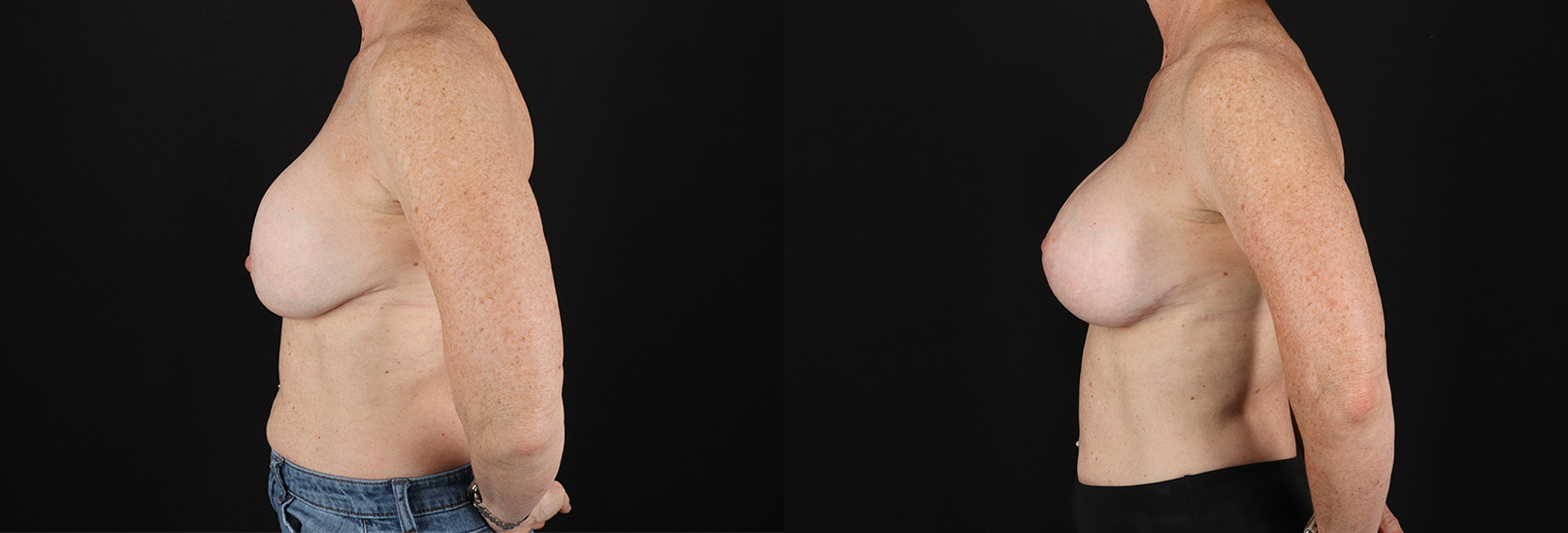 Revision Breast Surgery before and after photo by Dr. Erika A. Sato in Houston, TX
