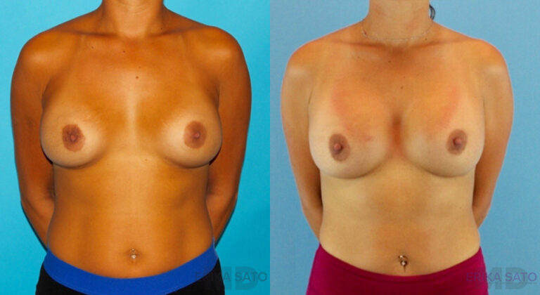 Revision Breast Surgery before and after photo by Dr. Erika A. Sato in Houston TX