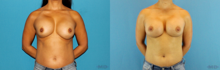 Revision Breast Surgery before and after photo by Dr. Erika A. Sato in Houston TX