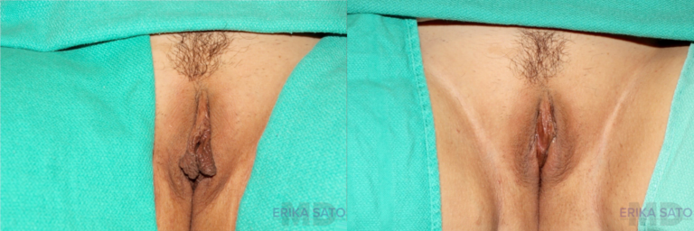 Labiaplasty before and after photo by Dr. Erika A. Sato in Houston TX