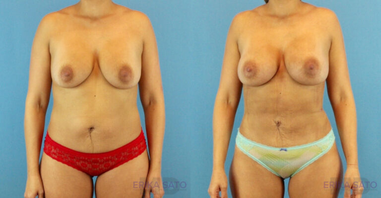 Fat Grafting to the Breast before and after photo by Dr. Erika A. Sato in Houston TX