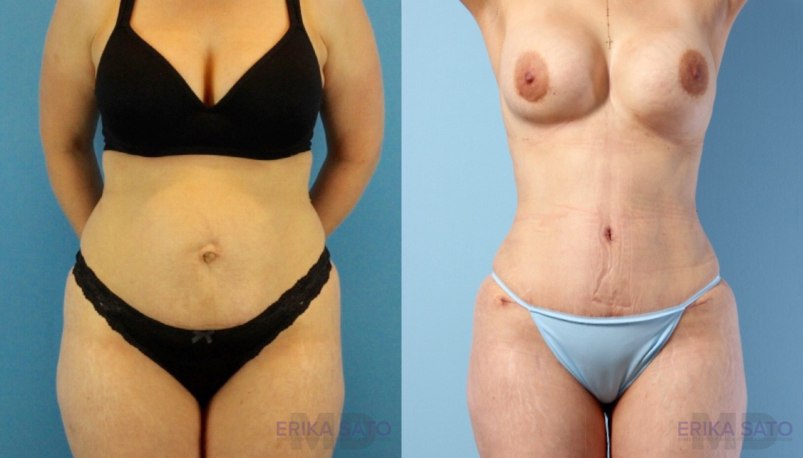 Brazilian Butt Lift before and after photo by Dr. Erika A. Sato in Houston TX