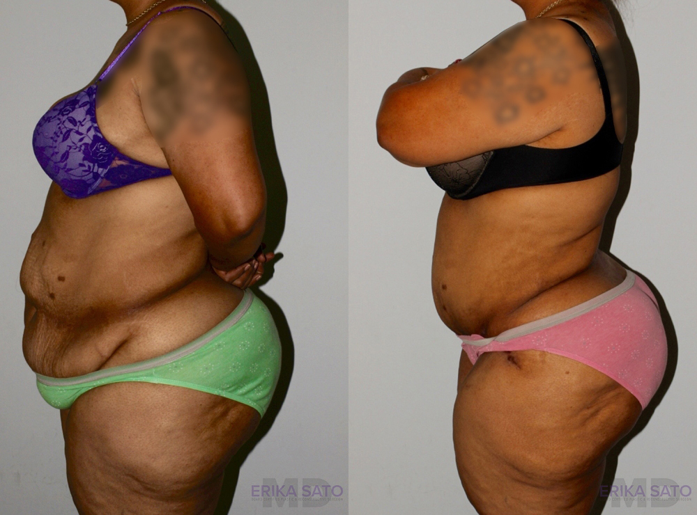 Post Bariatric Surgery Massive Weight Loss before and after photo by Dr. Erika A. Sato in Houston TX