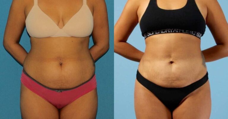 Liposuction before and after photo by Dr. Erika A. Sato in Houston TX