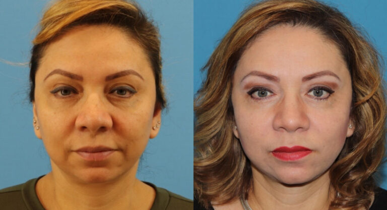 Laser before and after photo by Dr. Erika A. Sato in Houston TX