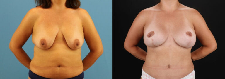 Mommy Makeover before and after photo by Dr. Erika A. Sato in Houston TX