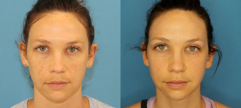Laser before and after photo by Dr. Erika A. Sato in Houston TX