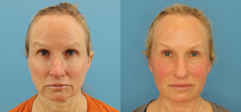 Profound RF Skin Tightening before and after photo by Dr. Erika A. Sato in Houston TX