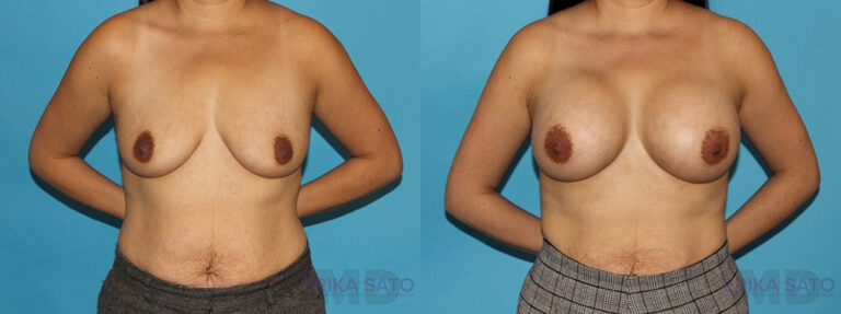 of Breast Augmentation before and after photo by Dr. Erika A. Sato in Houston TX