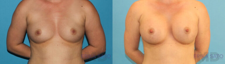 Breast Augmentation before and after photo by Dr. Erika A. Sato in Houston TX