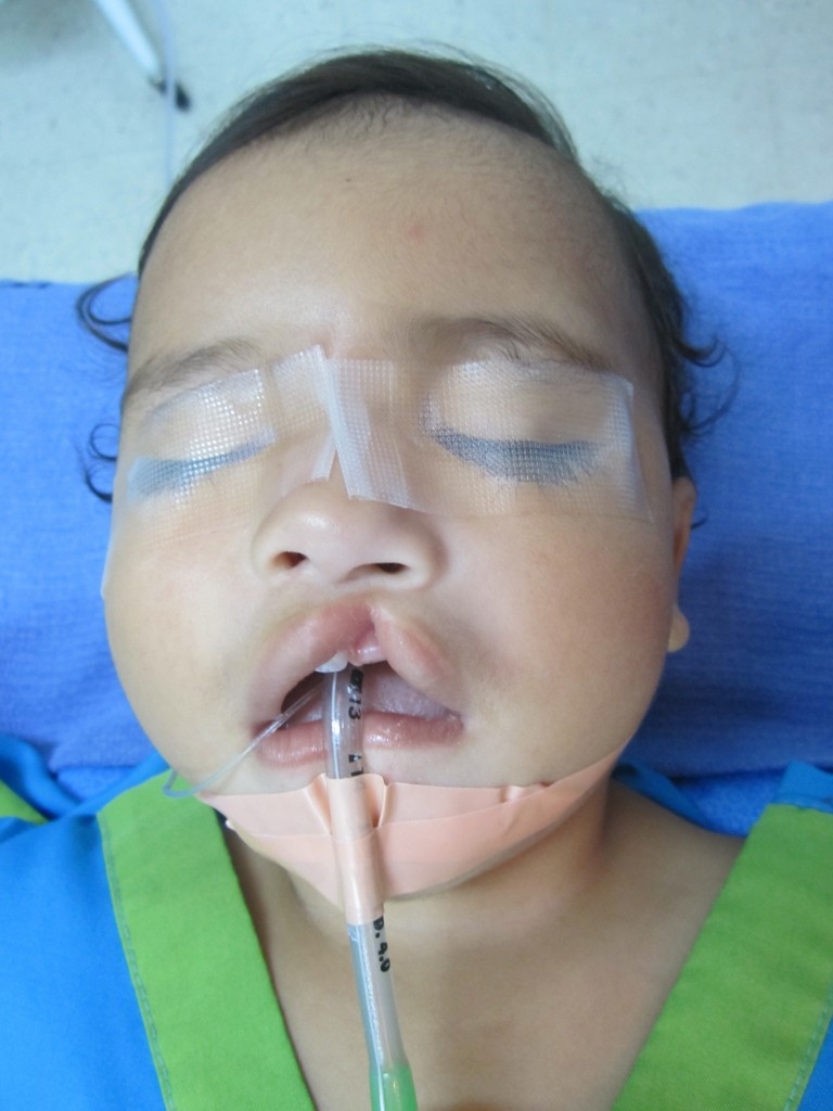 Sato's kid patient in Guatemala