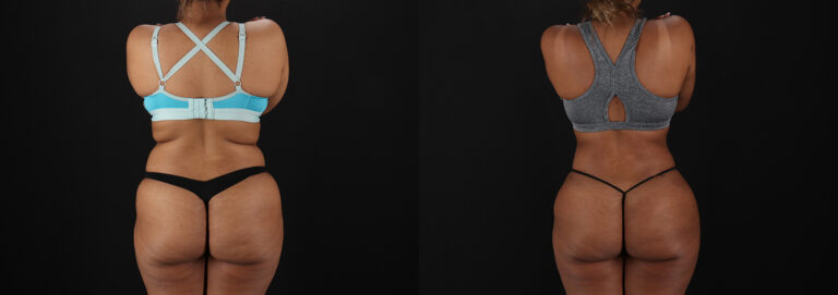 Brazilian Butt Lift before and after photo by Dr. Erika A. Sato in Houston, TX