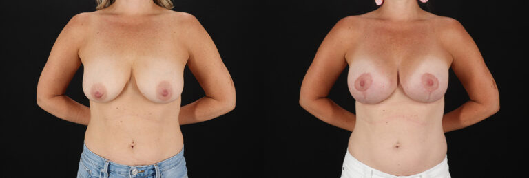 Breast Lift with Implants before and after photo by Dr. Erika A. Sato in Houston, TX