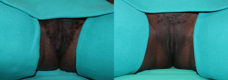 Labiaplasty before and after photo by Dr. Erika A. Sato in Houston, TX
