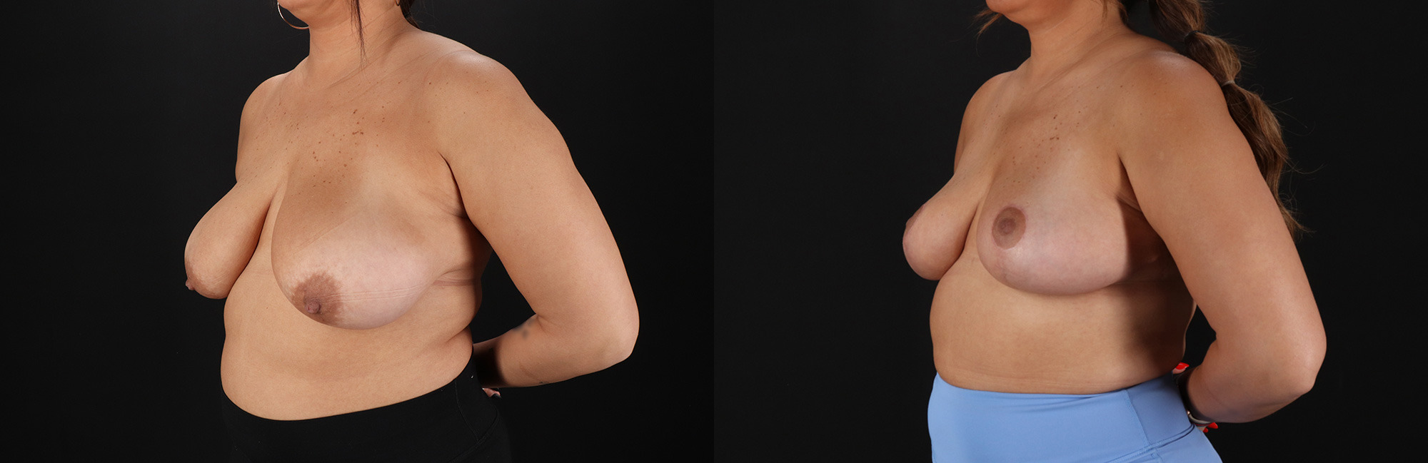 Breast Reduction before and after photo by Dr. Erika A. Sato in Houston, TX