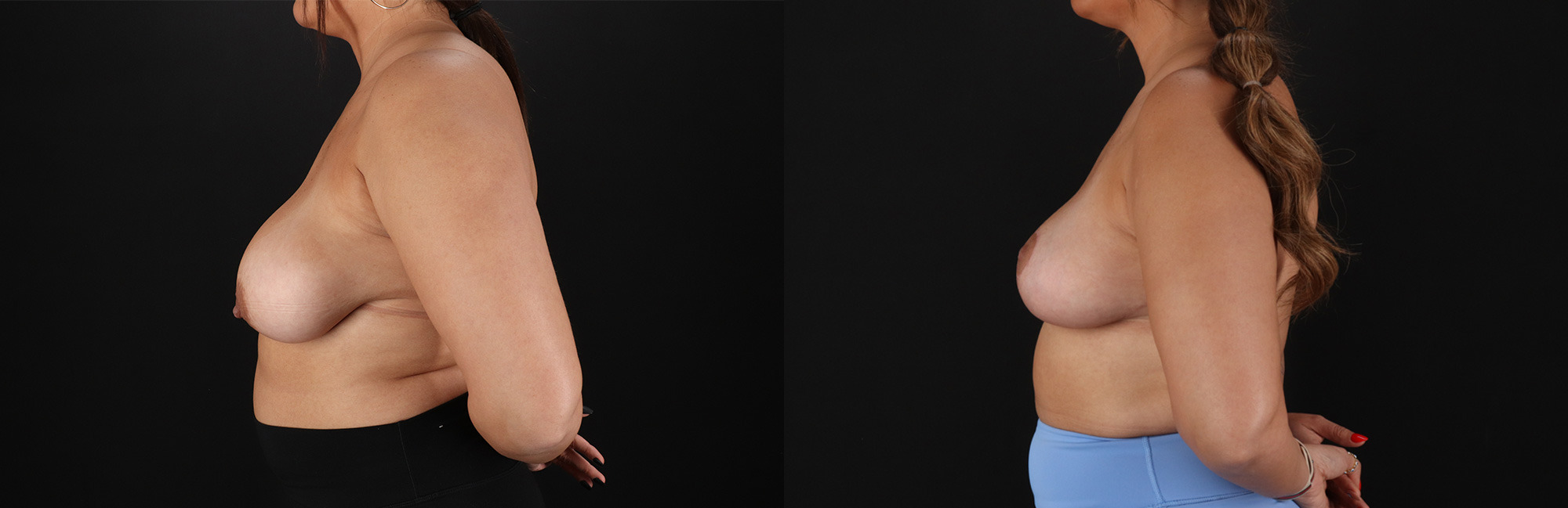 Breast Reduction before and after photo by Dr. Erika A. Sato in Houston, TX