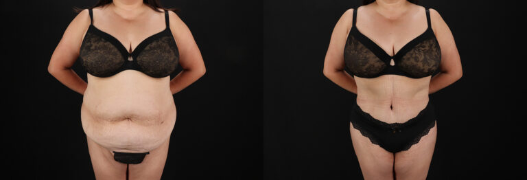 Tummy Tuck before and after photo by Dr. Erika A. Sato in Houston, TX