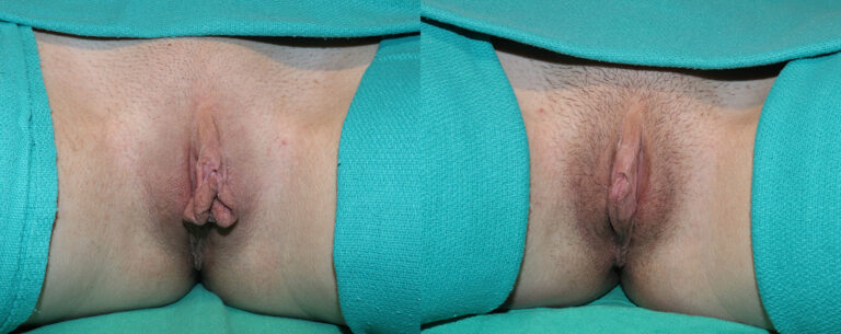 Labiaplasty before and after photo by Dr. Erika A. Sato in Houston TX copy